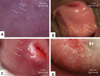 Female Genital Schistosomiasis Lesions Explored Using Circulating Anodic Antigen as an Indicator for Live Schistosoma Worms